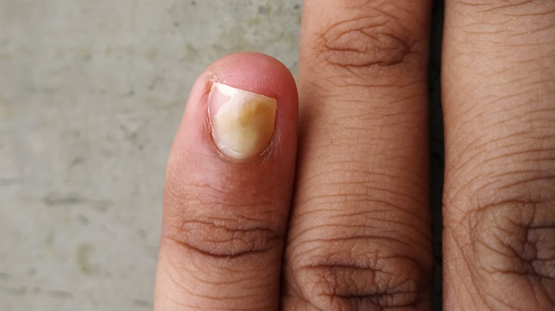 yellow discoloration on pinky fingernail