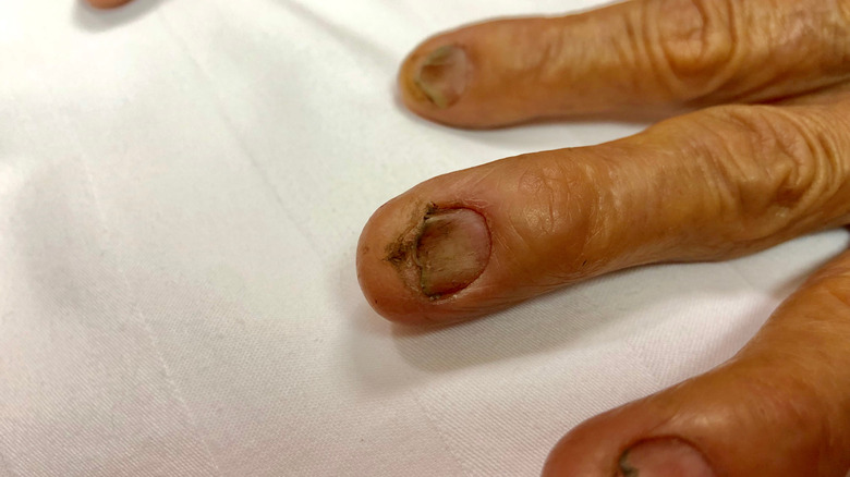 nail affected by Koilonychia