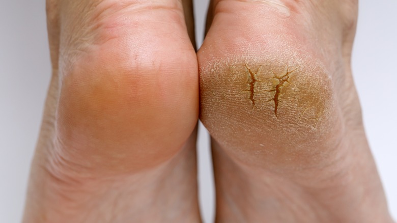 Cracked and smooth heels