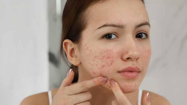 woman popping pimple on face
