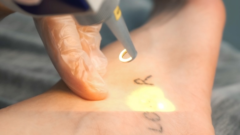 tattoo removal 
