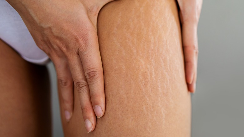 thin woman with stretch marks