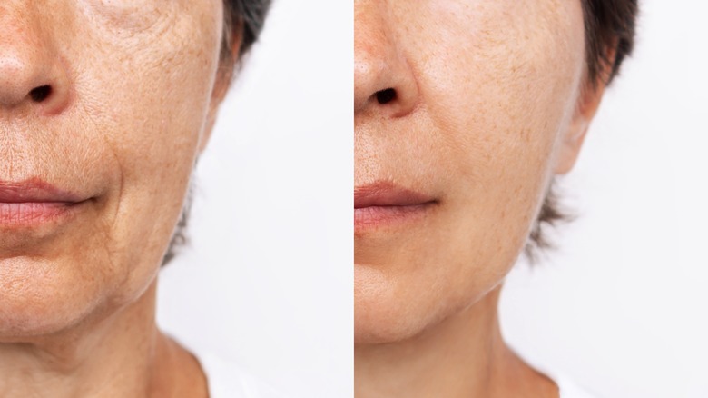 Filler before/after example