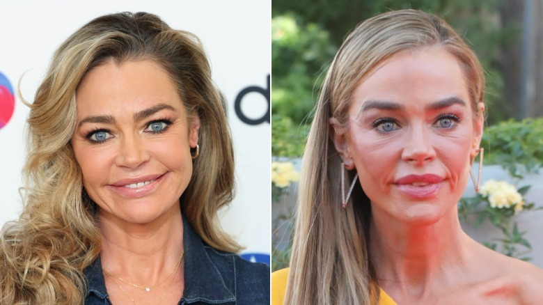 Side-by-side photos showing Denise Richards' face transformation after getting a facelift