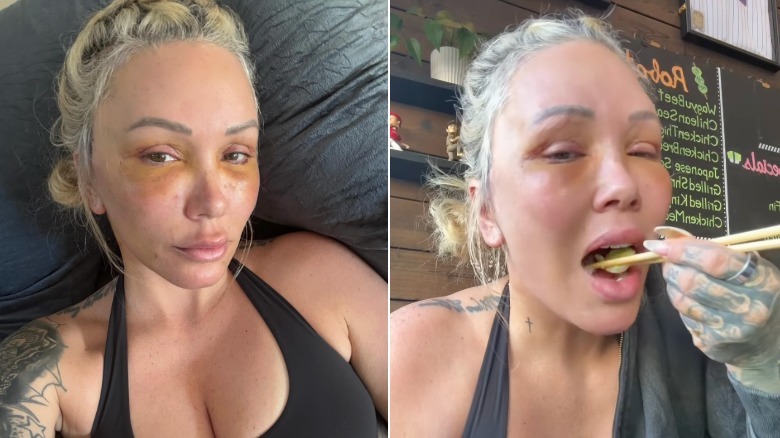 Bunnie Xo healing from facelift