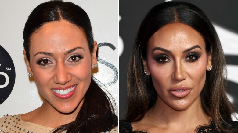 Side-by-side photos showing Melissa Gorga's plastic surgery